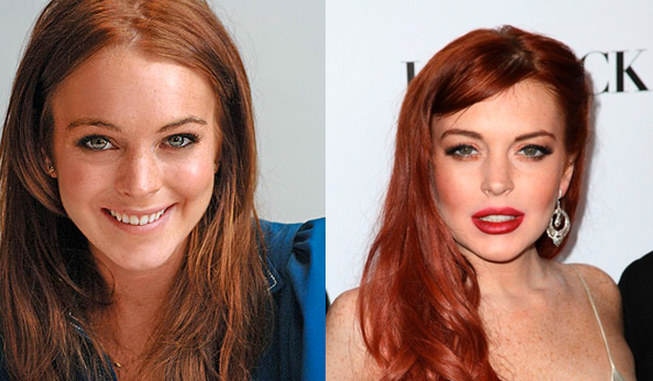 Worst celebrity plastic surgery fails