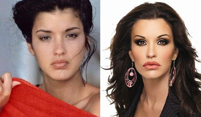 Worst celebrity plastic surgery fails