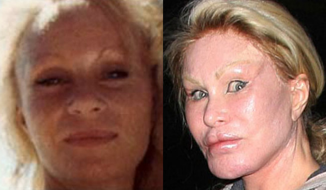 Worst celebrity plastic surgery fails